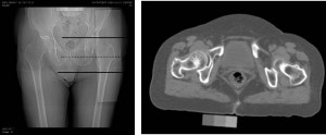 Quantitative computed tomography (QCT) images of hip bones. (T. Lang, University of California, San Francisco)